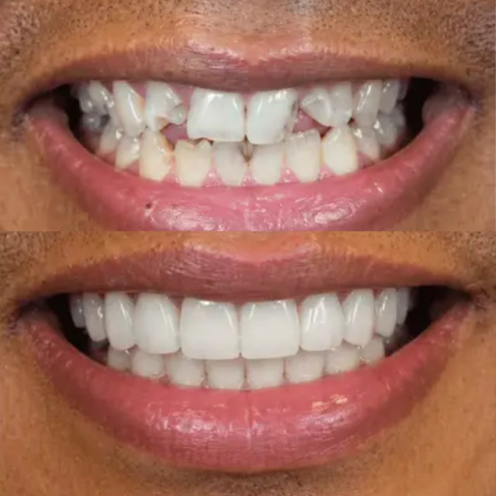 Aesthetic ceramic veneers and radiant smile transformation at Smile And Skin Co.
