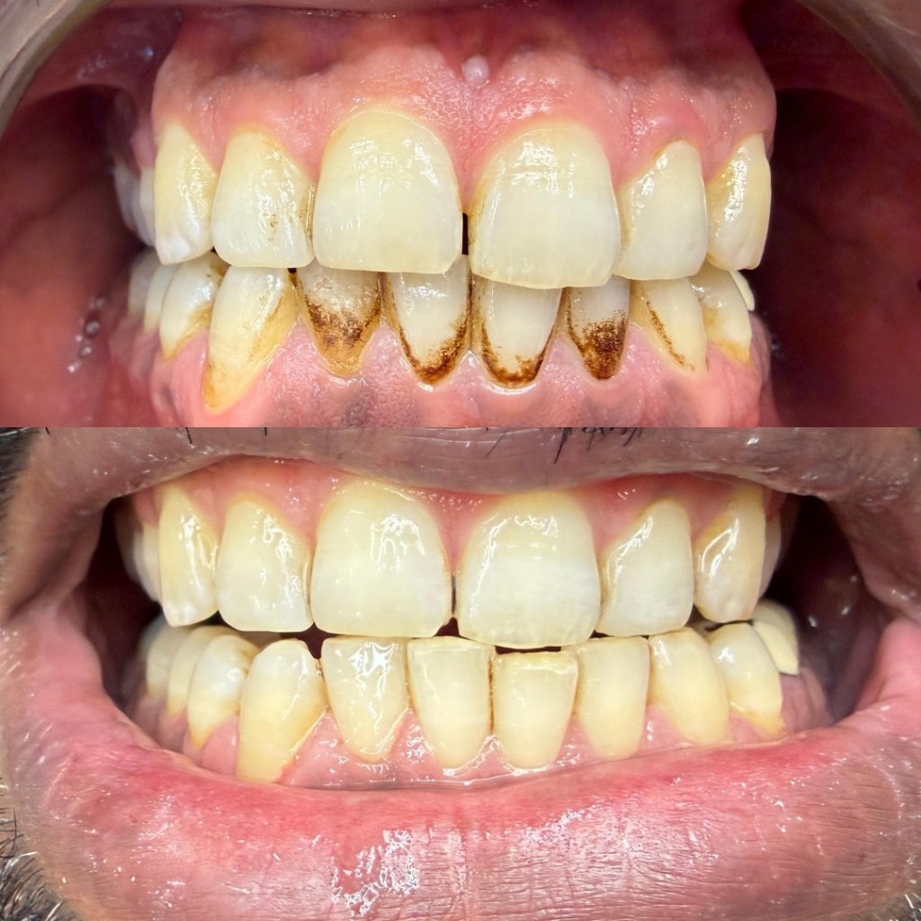 Periodontal deep scaling and calculus removal patient result at Smile And Skin Co.